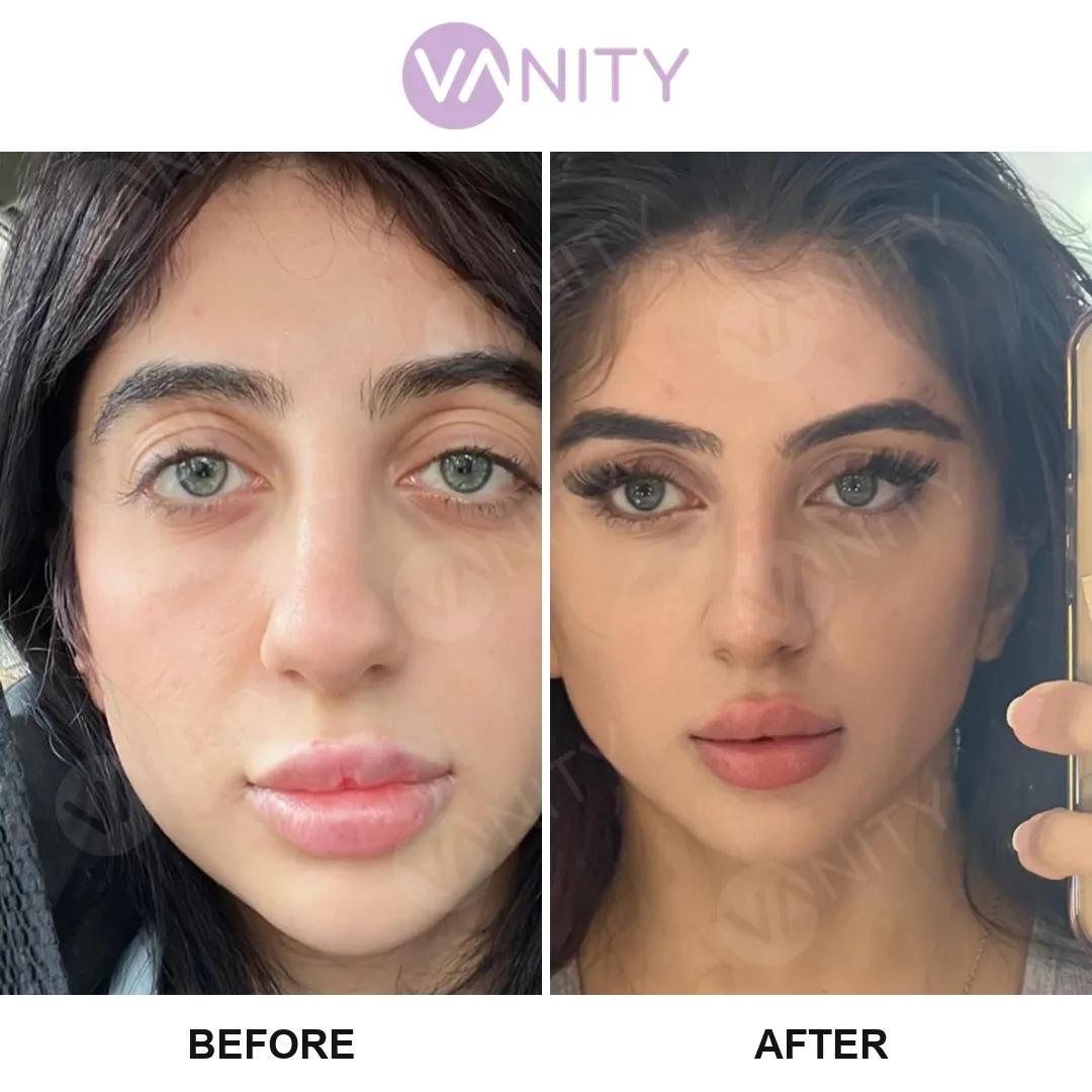 Face Lift Istanbul