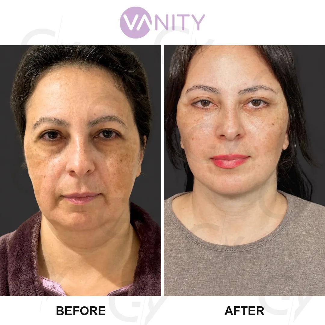 Face Lift Istanbul