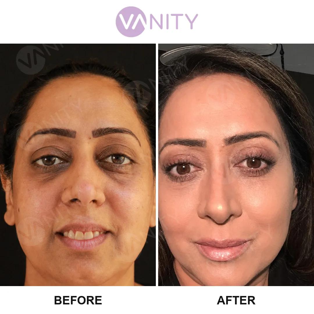 Blepharoplasty Istanbul