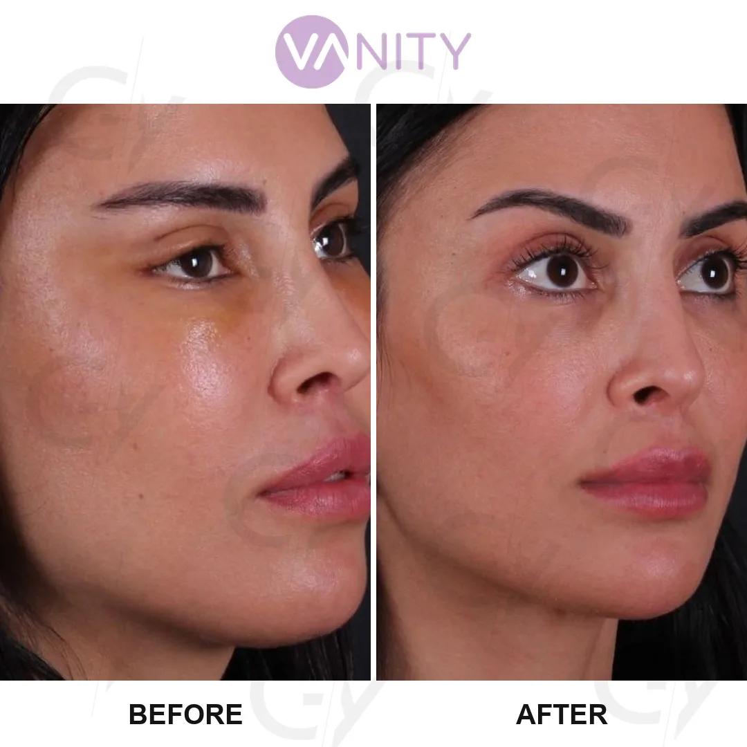 Blepharoplasty Istanbul