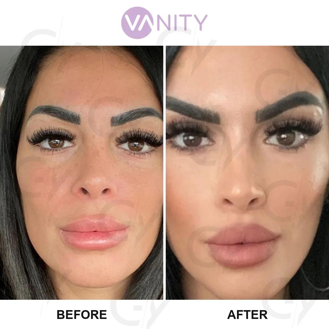 Blepharoplasty Istanbul