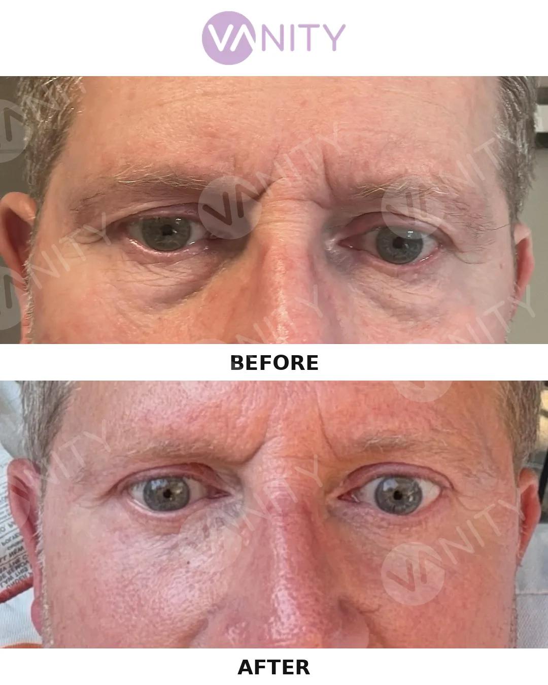 Blepharoplasty Istanbul