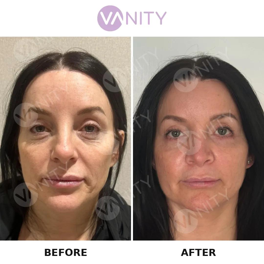 Blepharoplasty Istanbul