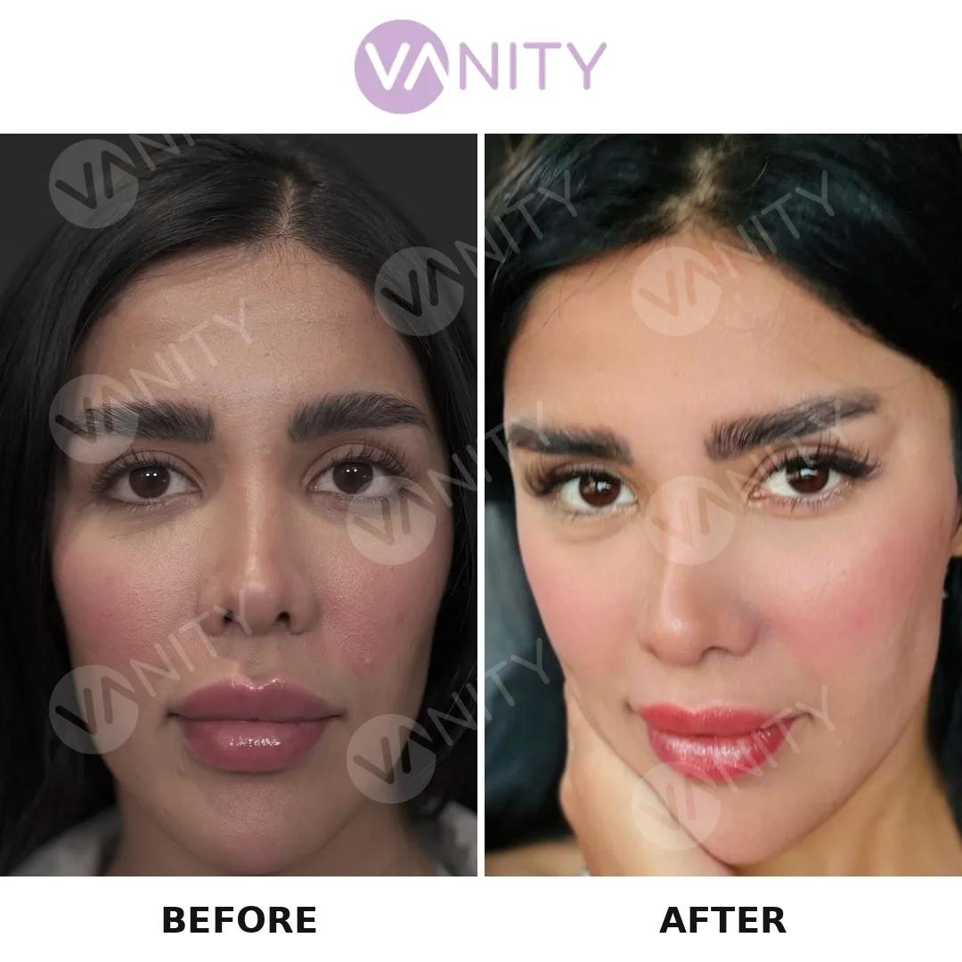 Blepharoplasty Istanbul