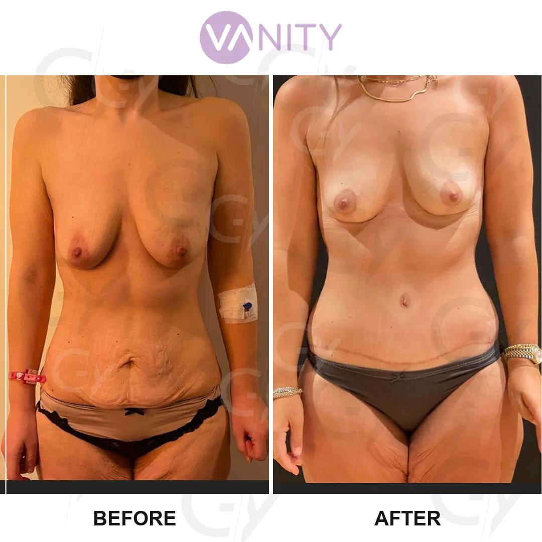 Tummy tuck Istanbul