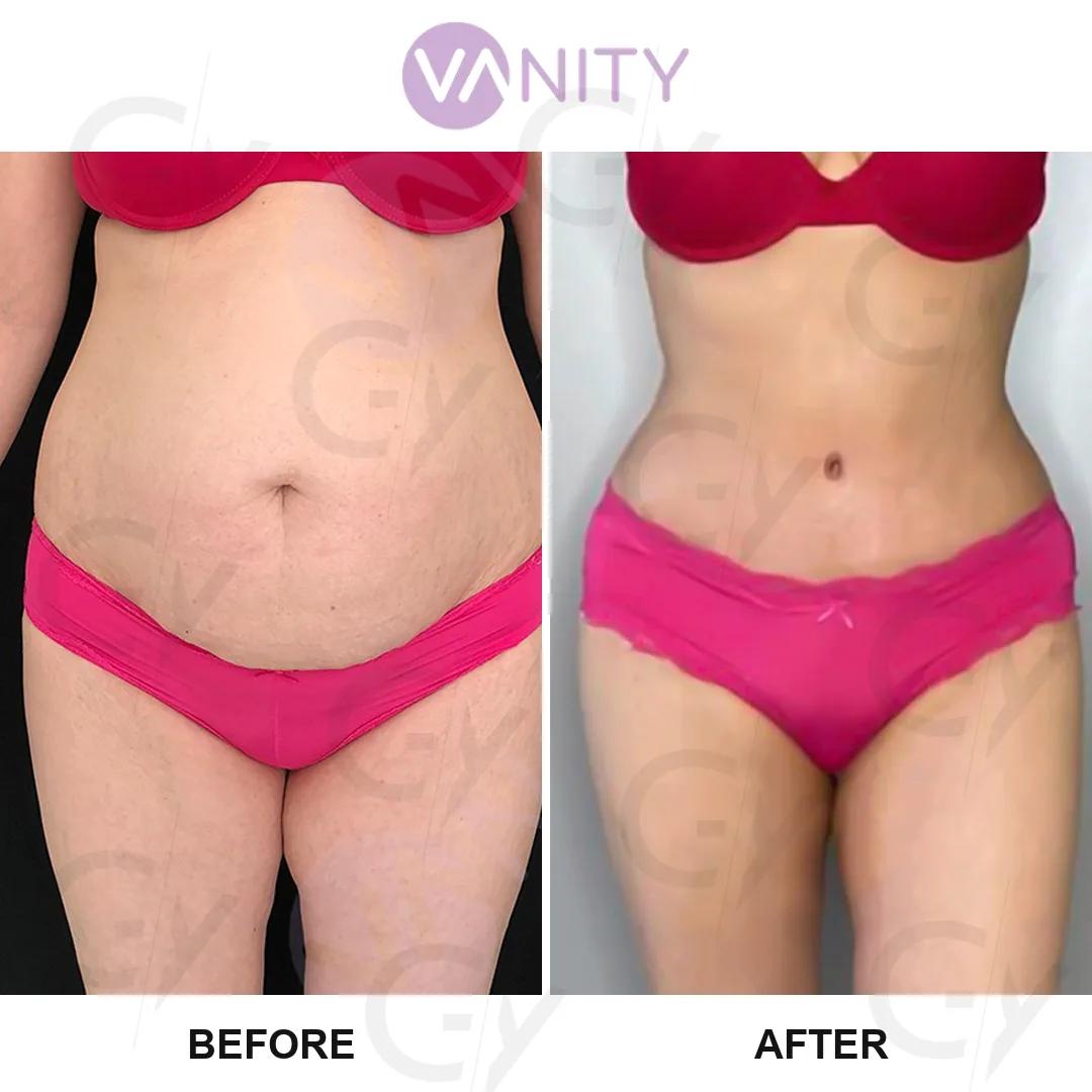 Tummy tuck Istanbul