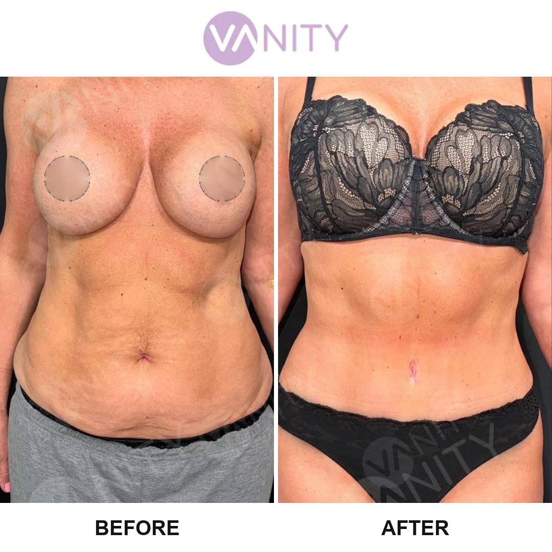 Tummy tuck Istanbul