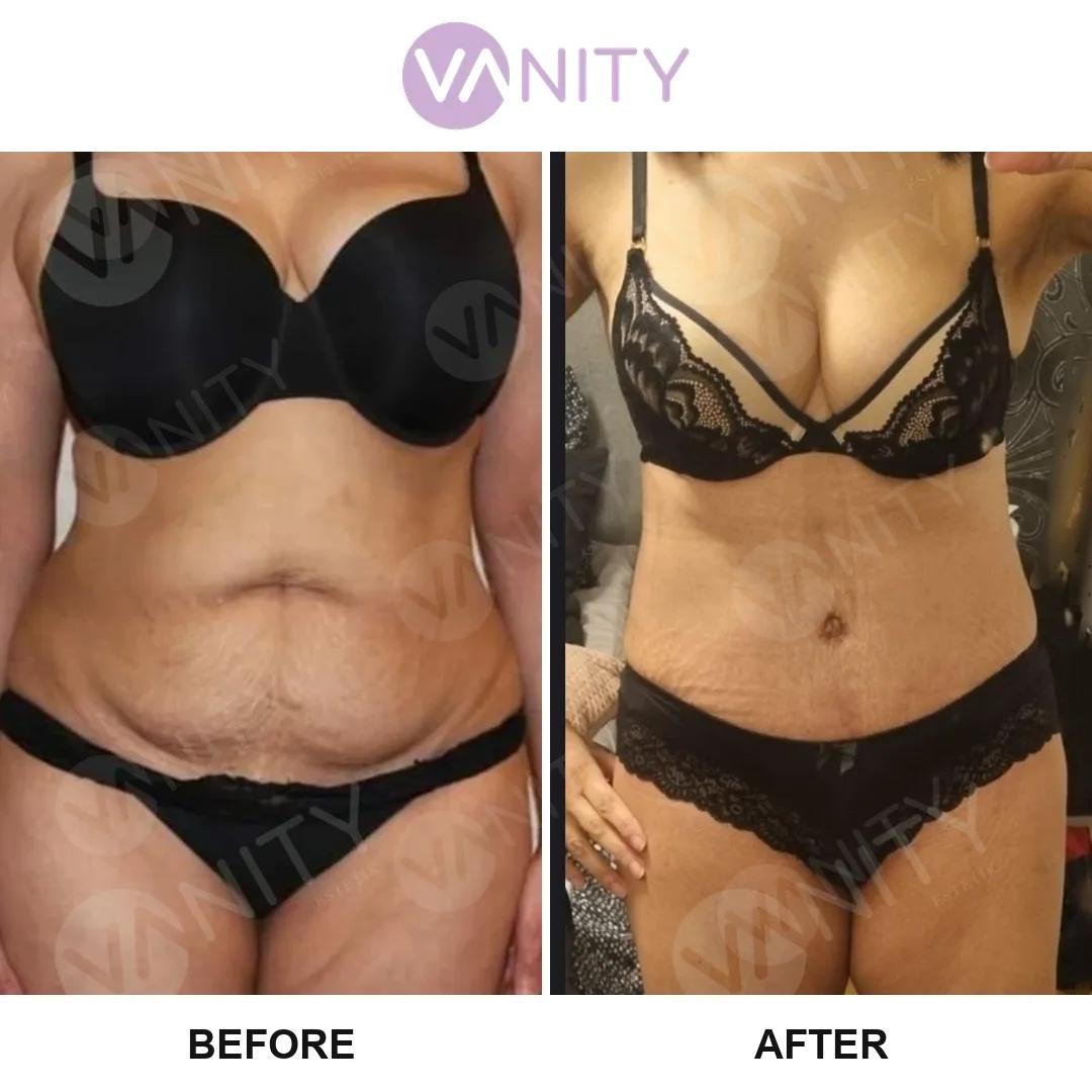 Tummy tuck Istanbul
