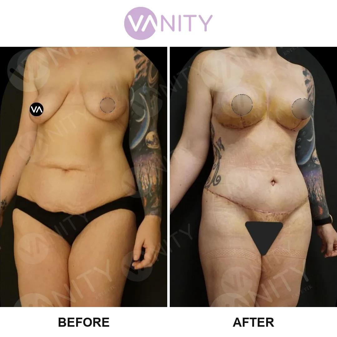 Tummy tuck Istanbul