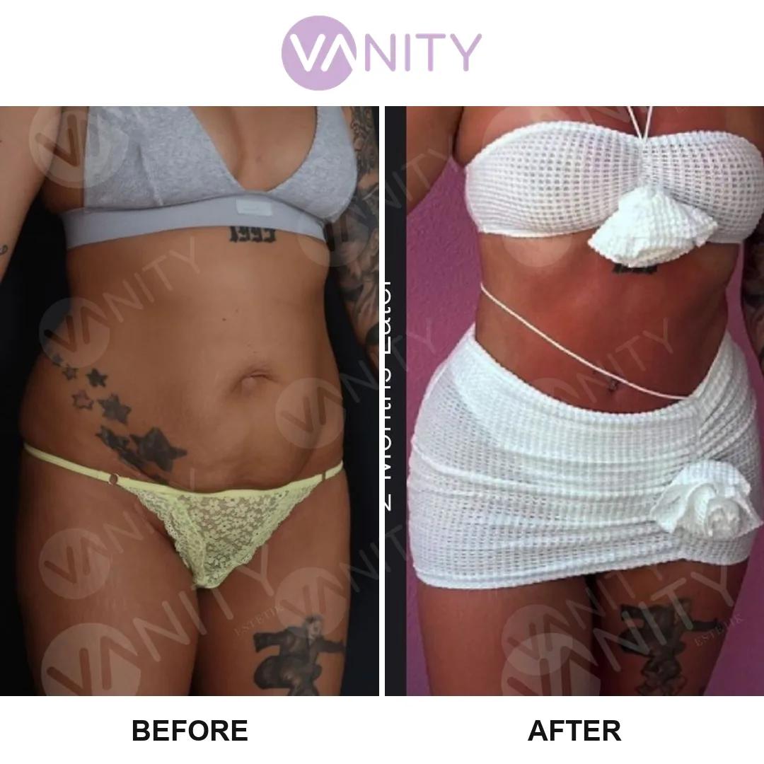 Tummy tuck Istanbul