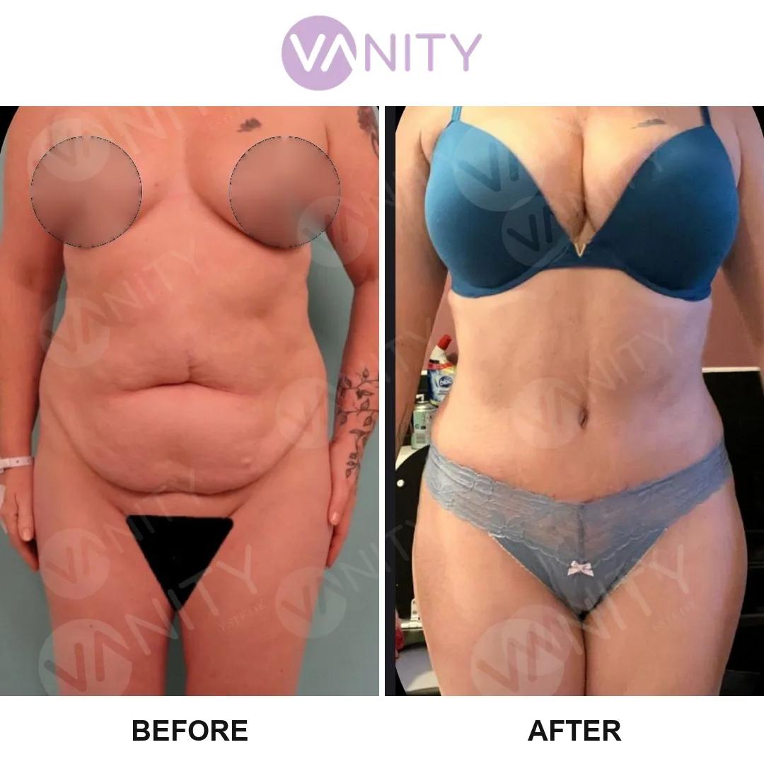Tummy tuck Istanbul