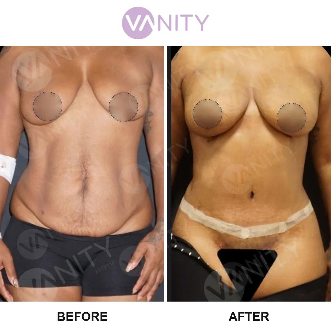 Tummy tuck Istanbul