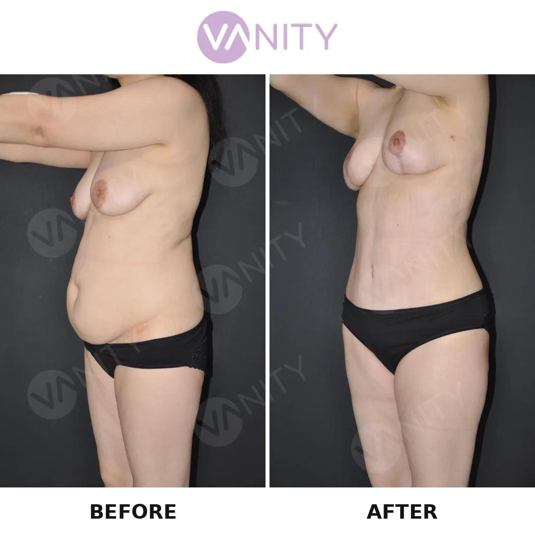 Tummy tuck Istanbul