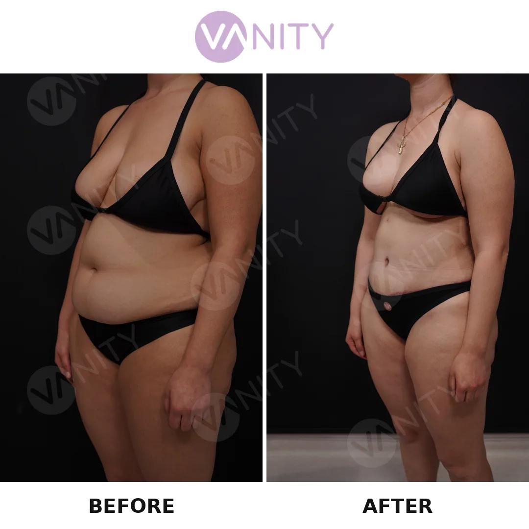 Tummy tuck Istanbul