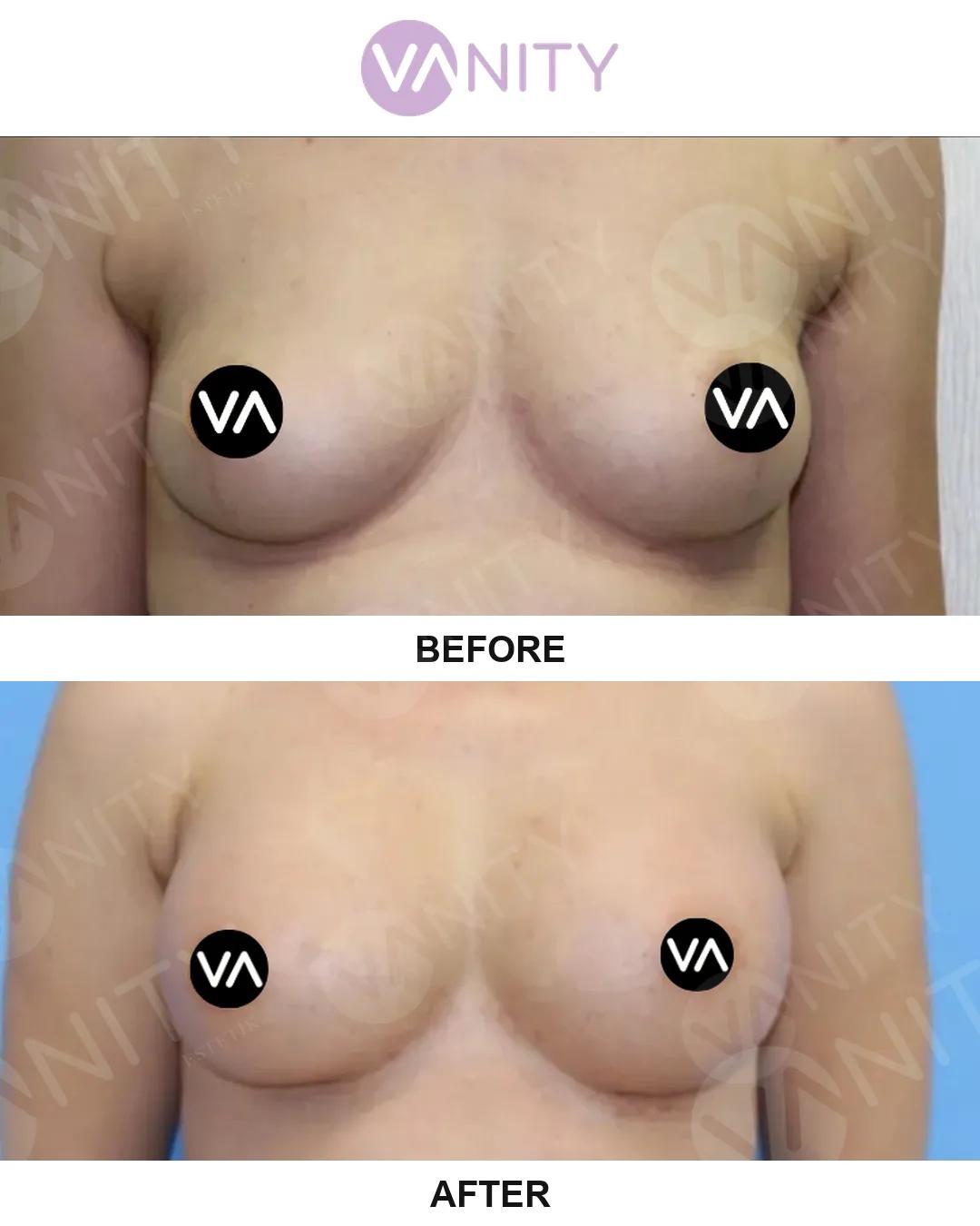 Breast augmentation istanbul