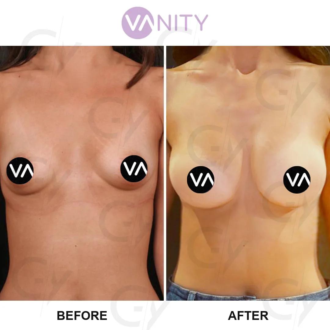 Breast augmentation istanbul