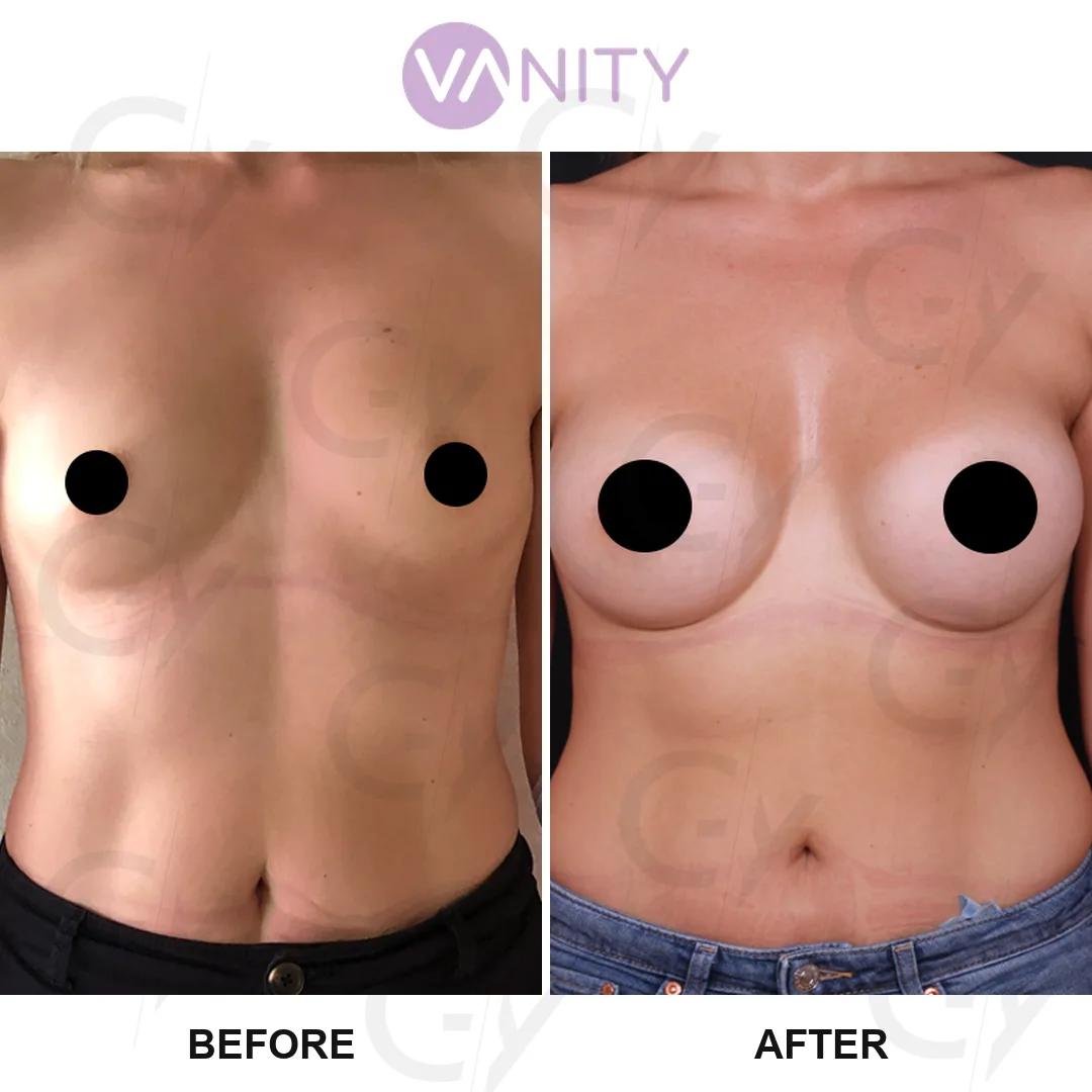 Breast augmentation istanbul