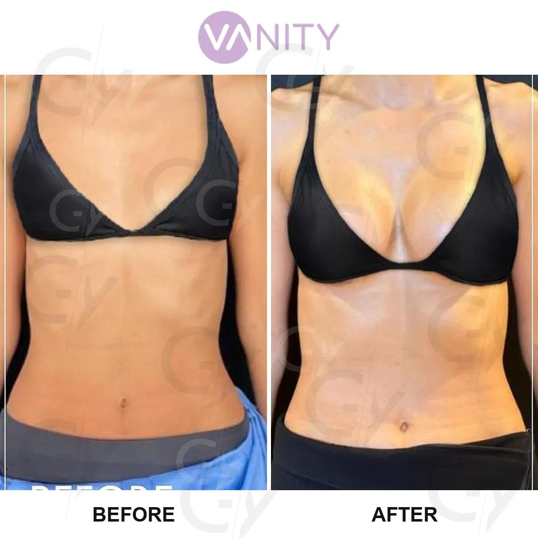Breast augmentation istanbul