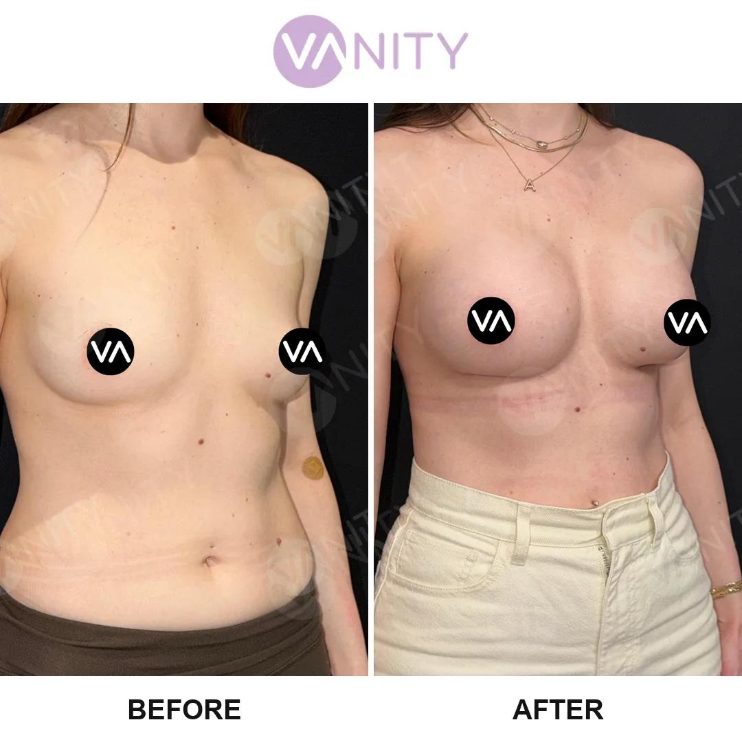 Breast augmentation istanbul