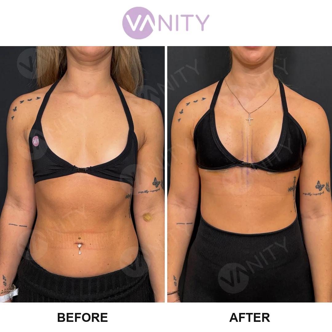 Breast augmentation istanbul