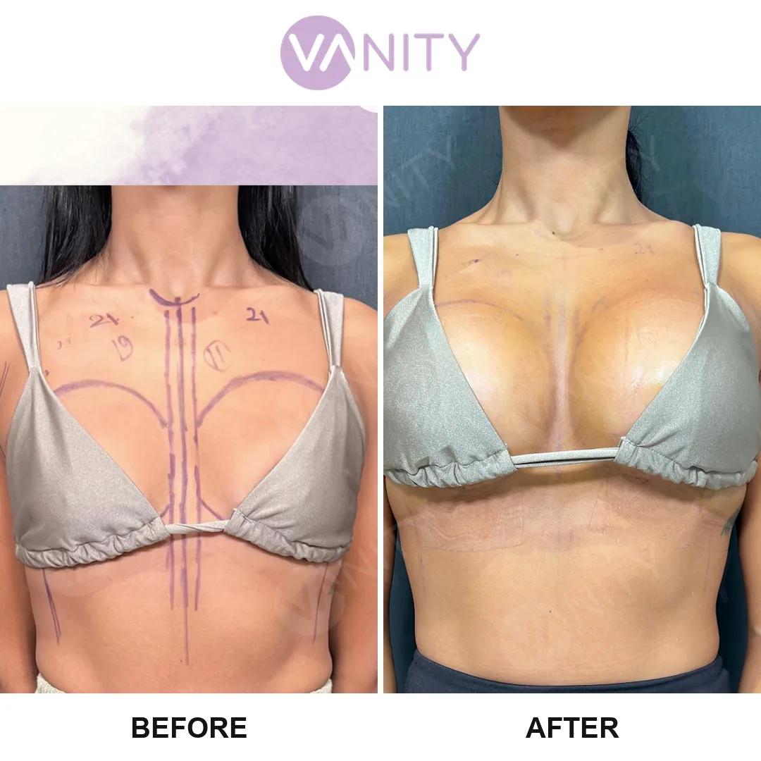 Breast augmentation istanbul