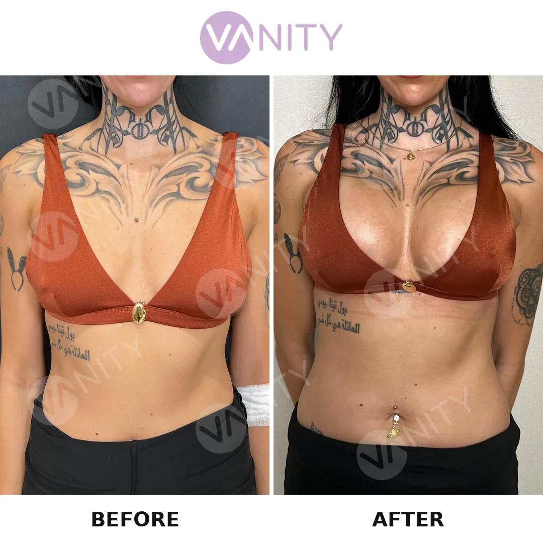 Breast augmentation istanbul