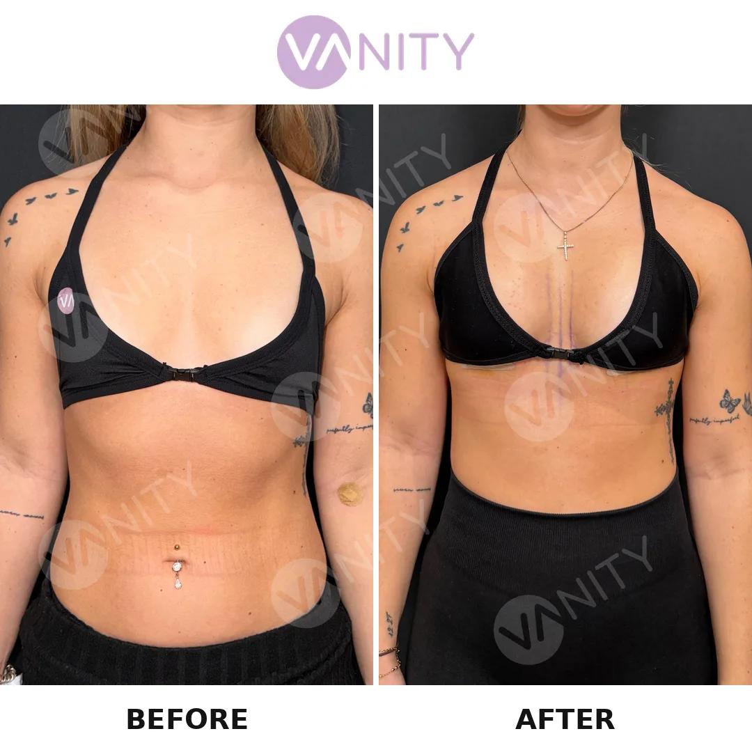 Breast augmentation istanbul