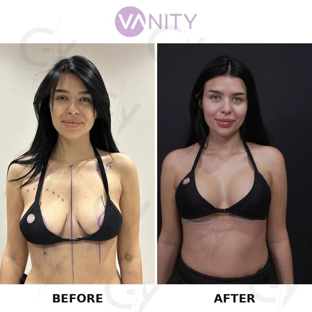 Breast augmentation istanbul