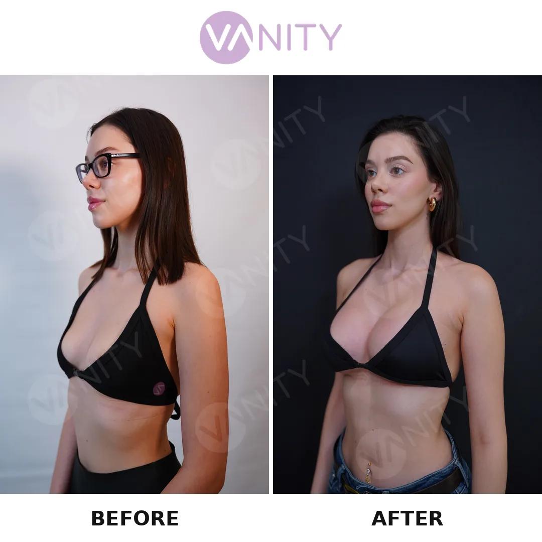 Breast augmentation istanbul