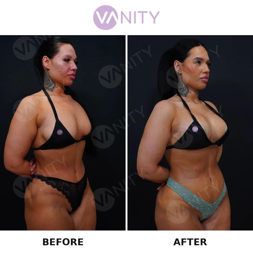 Breast augmentation istanbul