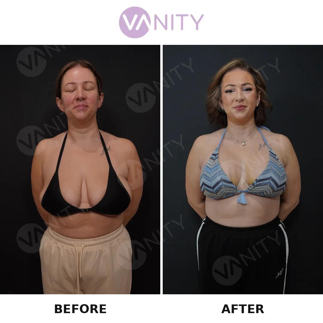 Breast augmentation istanbul