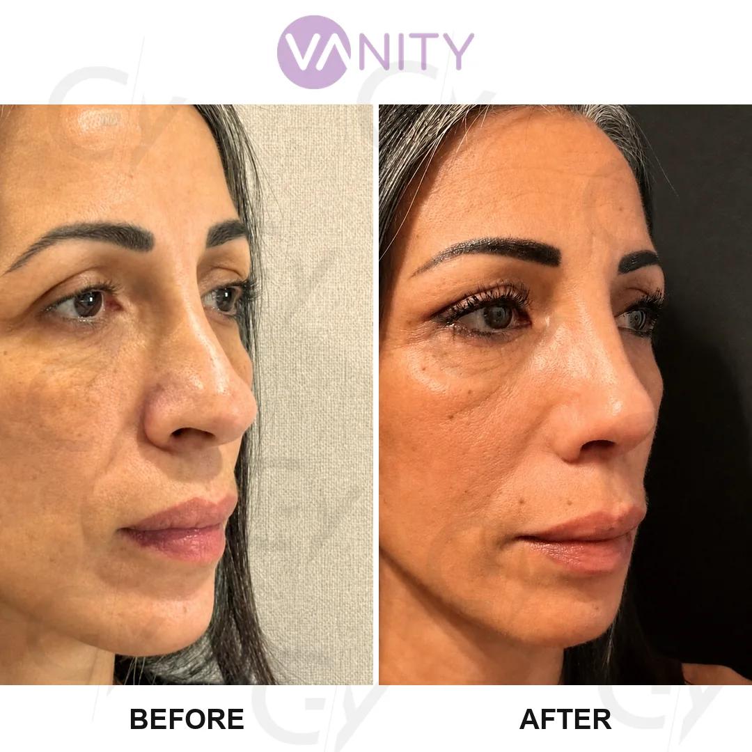 Rhinoplasty Istanbul