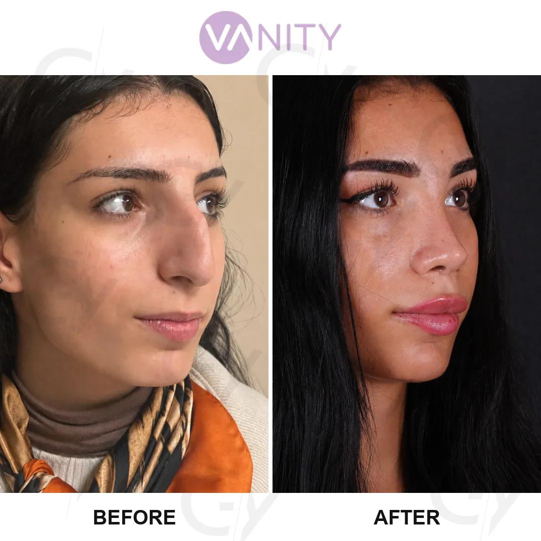 Rhinoplasty Istanbul