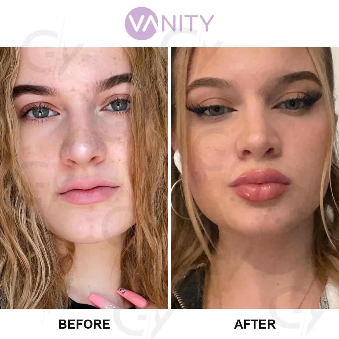 Rhinoplasty Istanbul