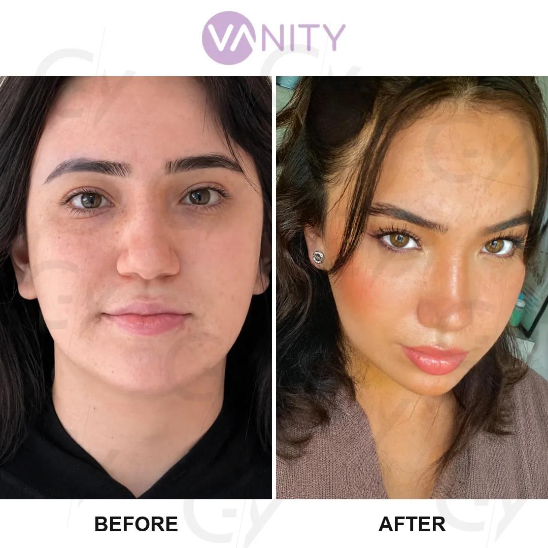 Rhinoplasty Istanbul
