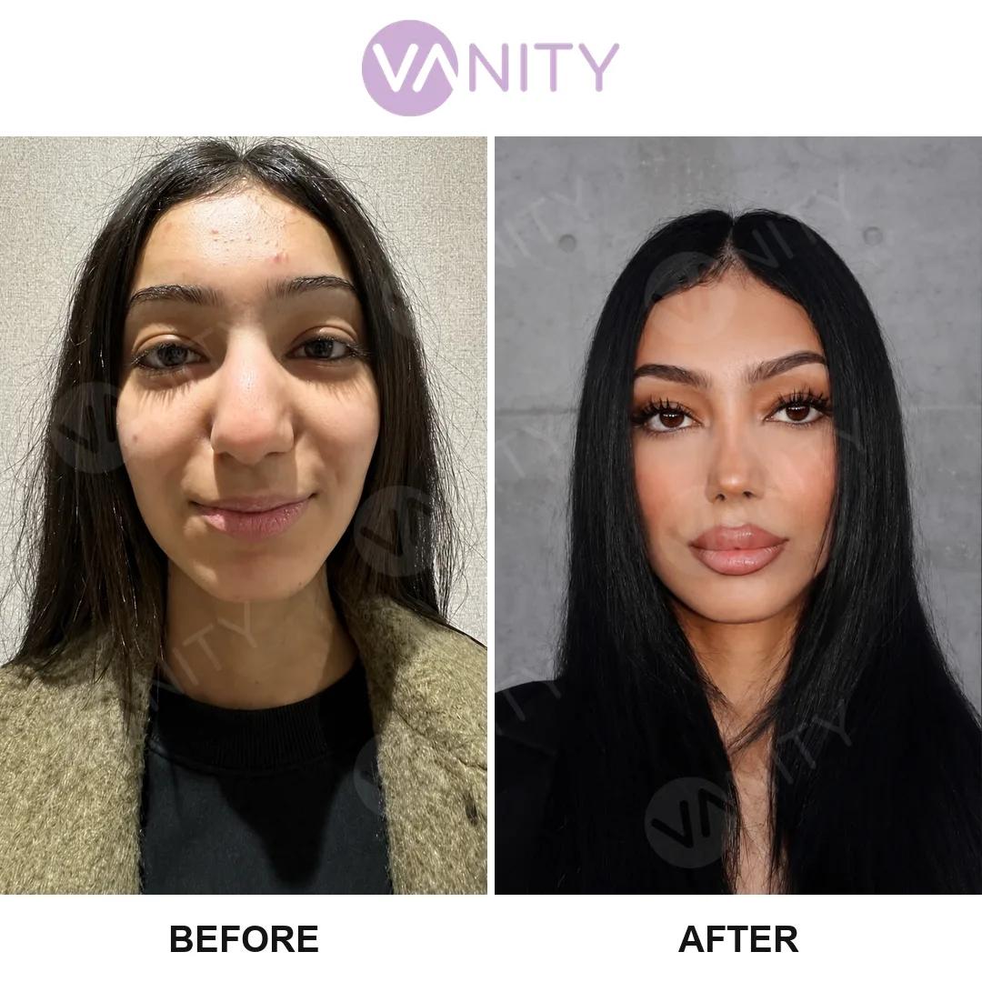Rhinoplasty Istanbul