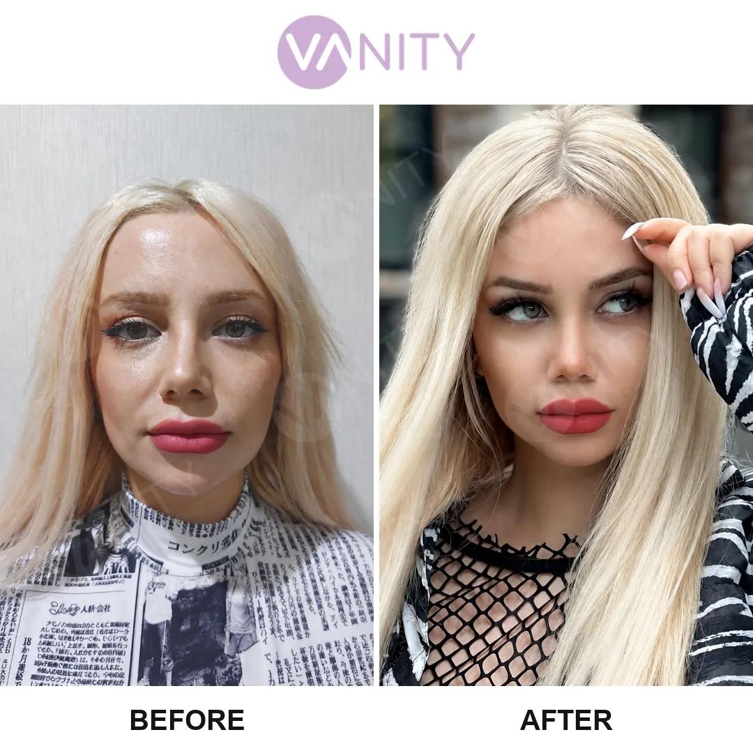 Rhinoplasty Istanbul