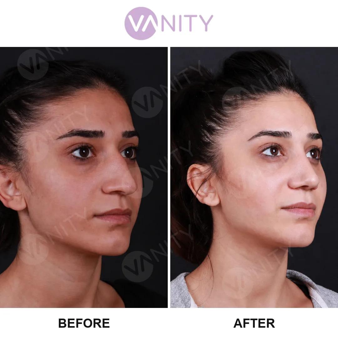 Rhinoplasty Istanbul