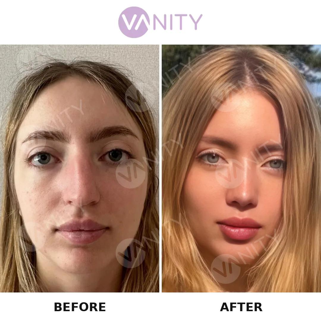 Rhinoplasty Istanbul