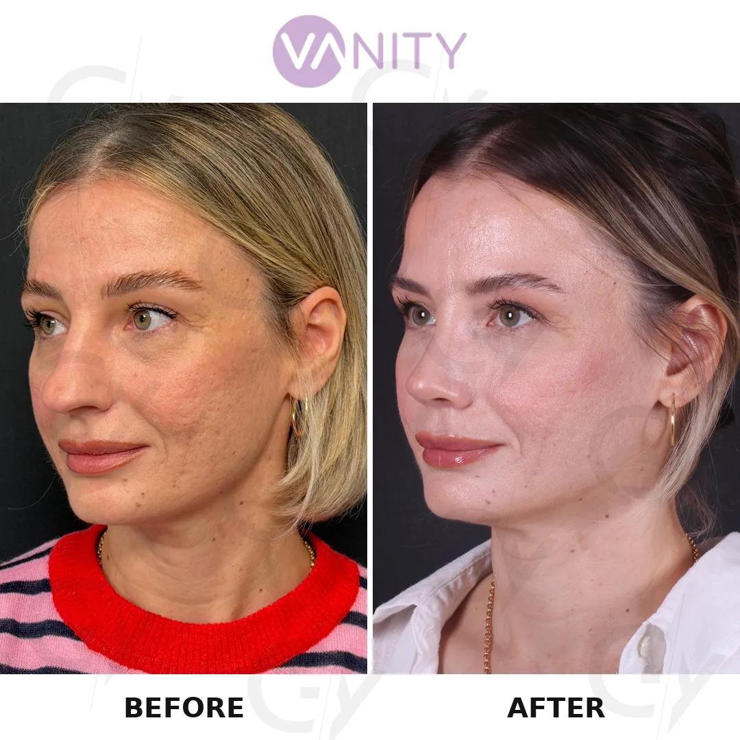 Rhinoplasty Istanbul