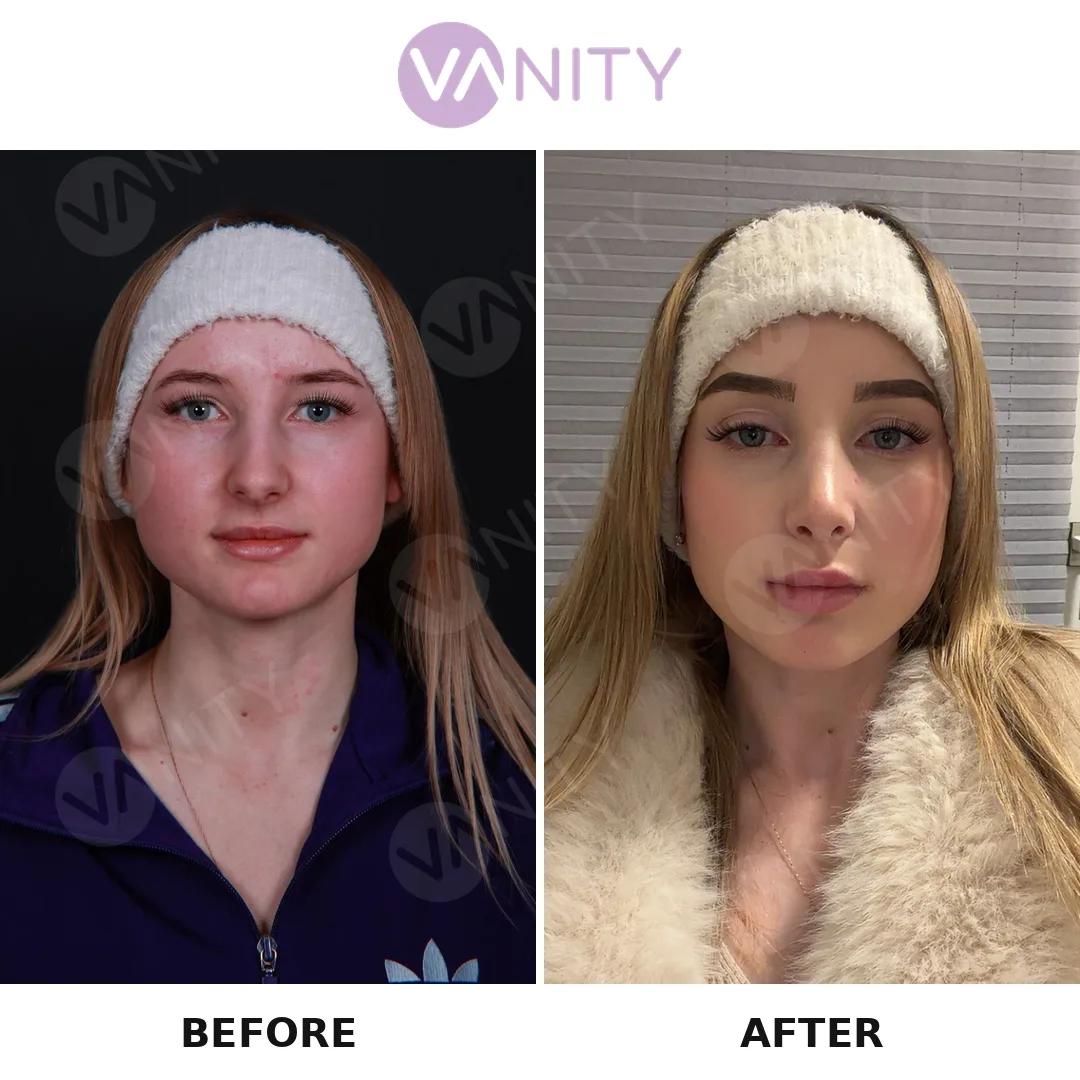 Rhinoplasty Istanbul