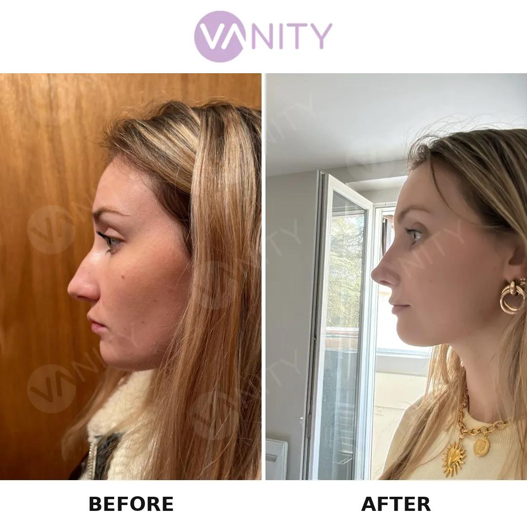 Rhinoplasty Istanbul