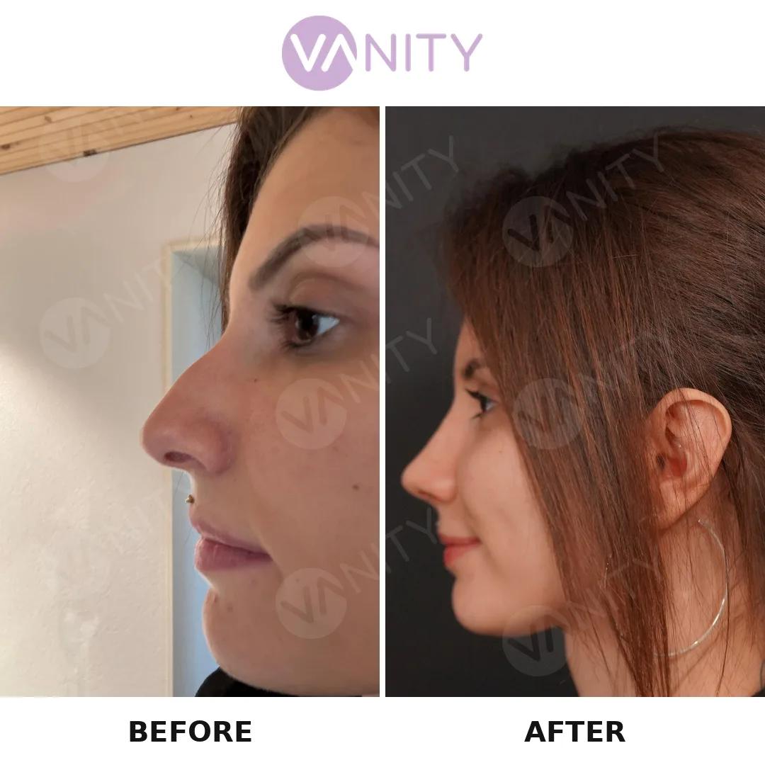 Rhinoplasty Istanbul