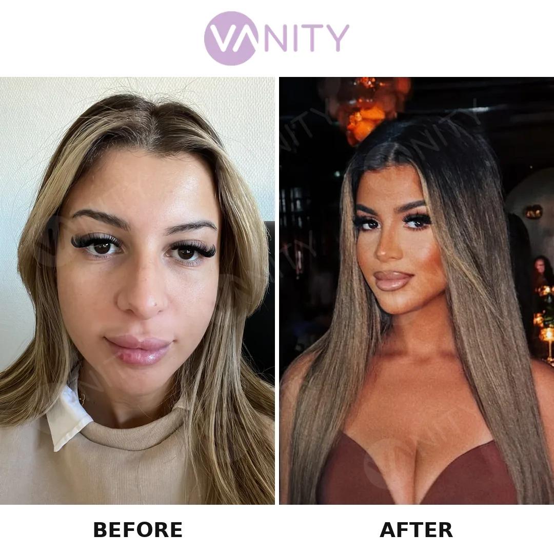 Rhinoplasty Istanbul