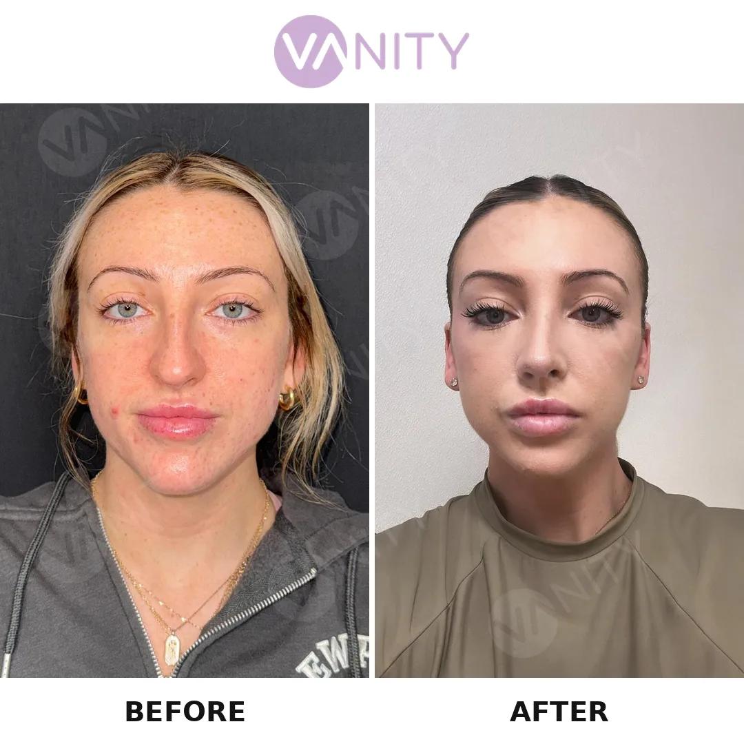 Rhinoplasty Istanbul