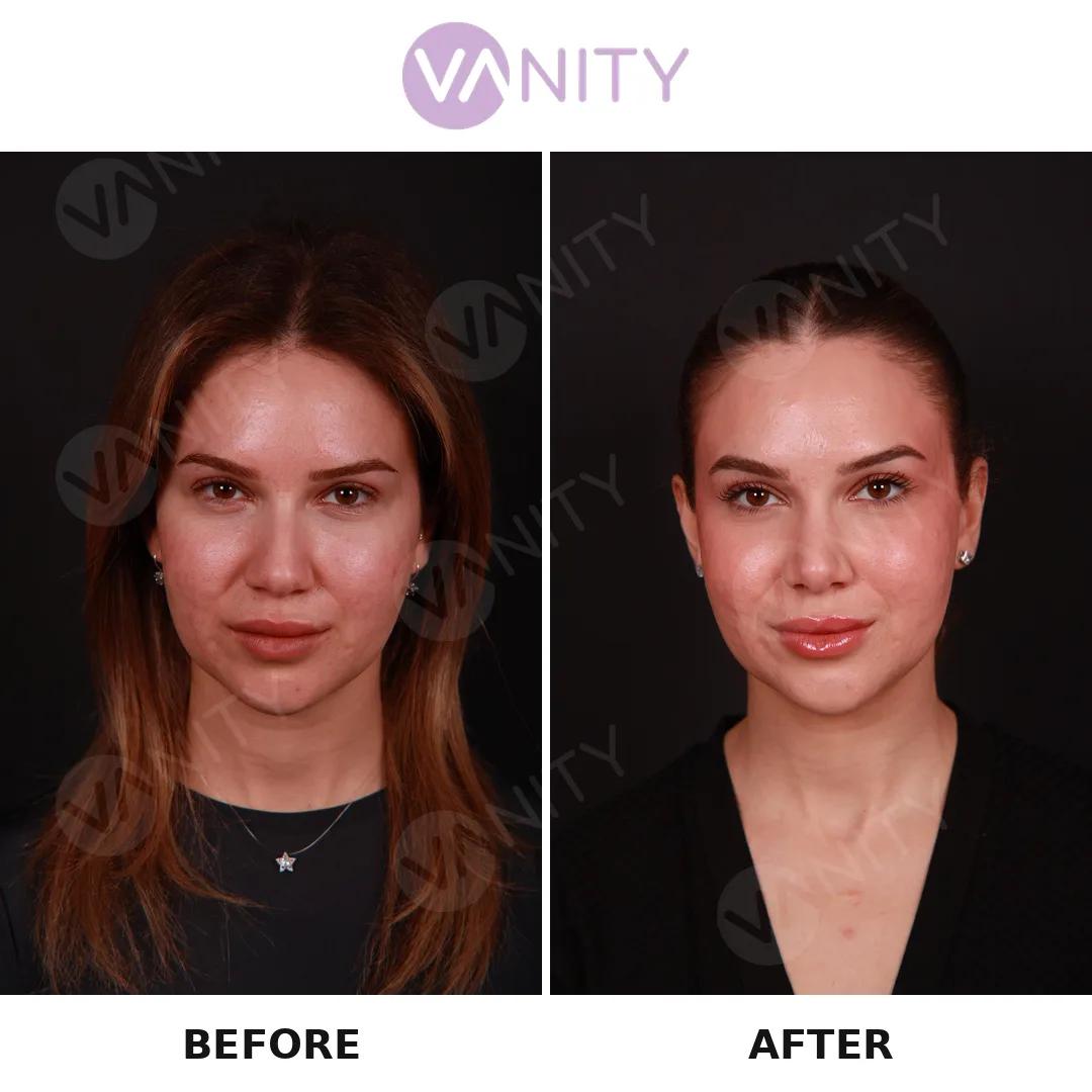 Rhinoplasty Istanbul