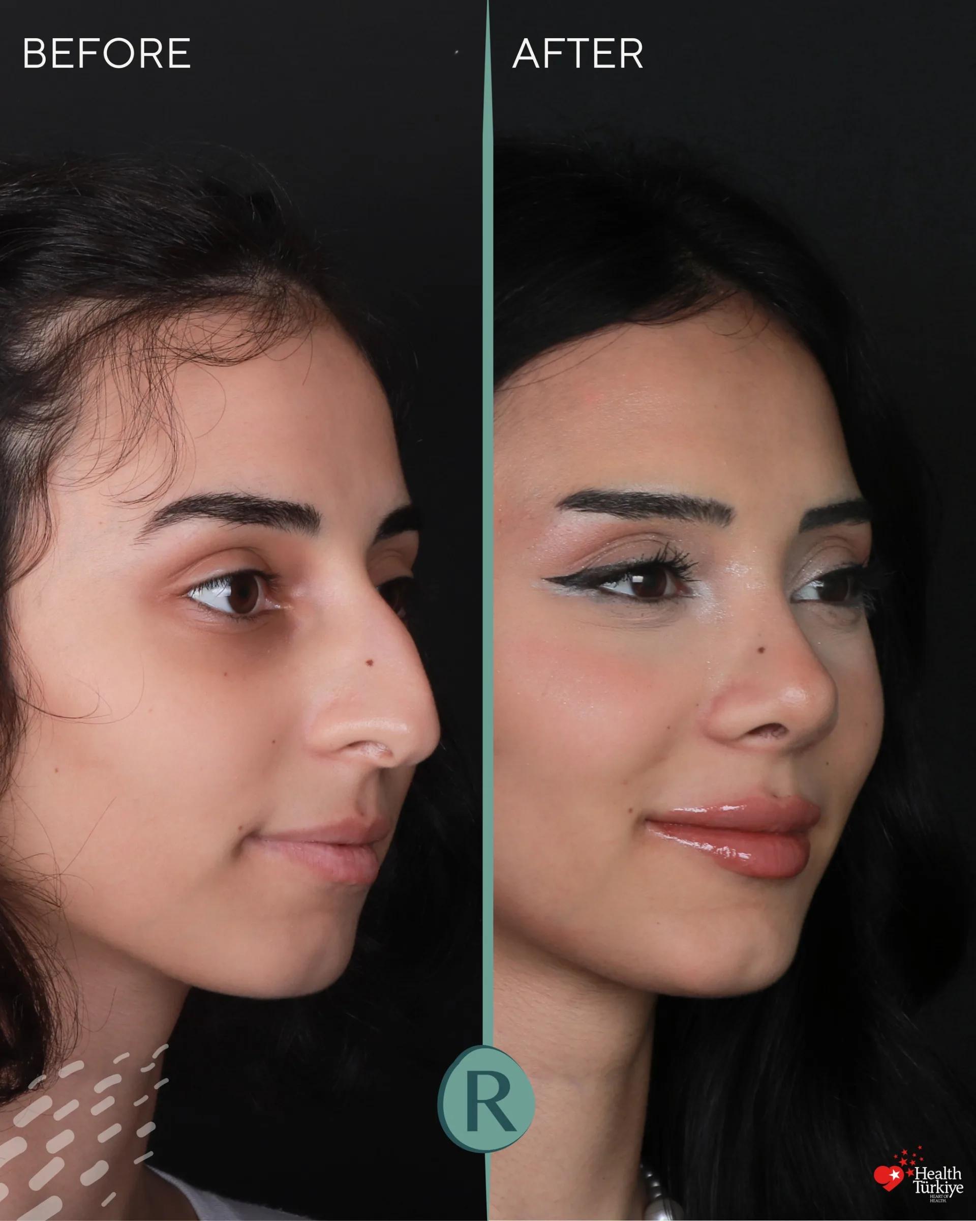 Rhinoplasty Istanbul