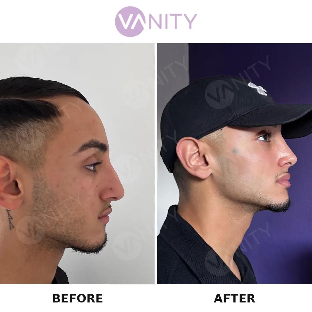 Rhinoplasty Istanbul