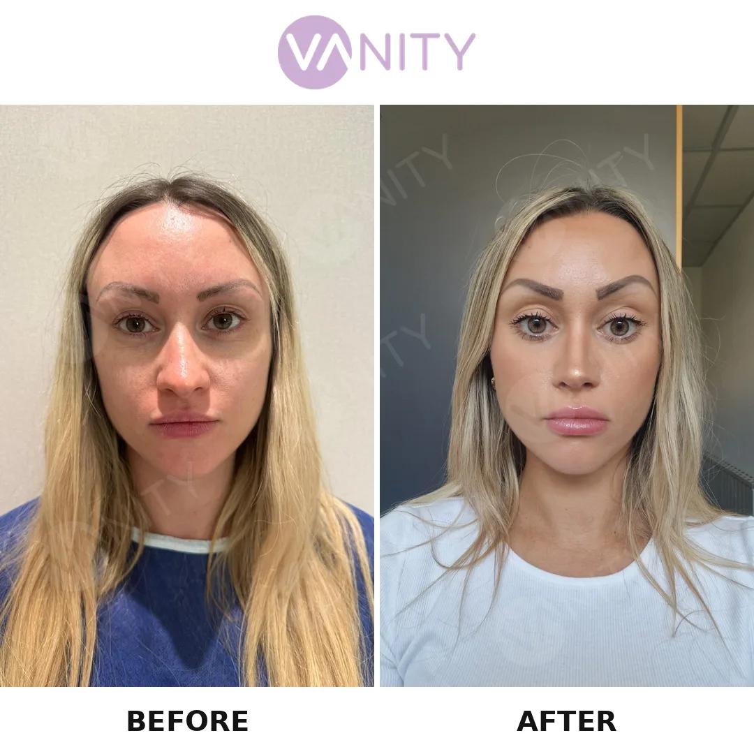 Rhinoplasty Istanbul
