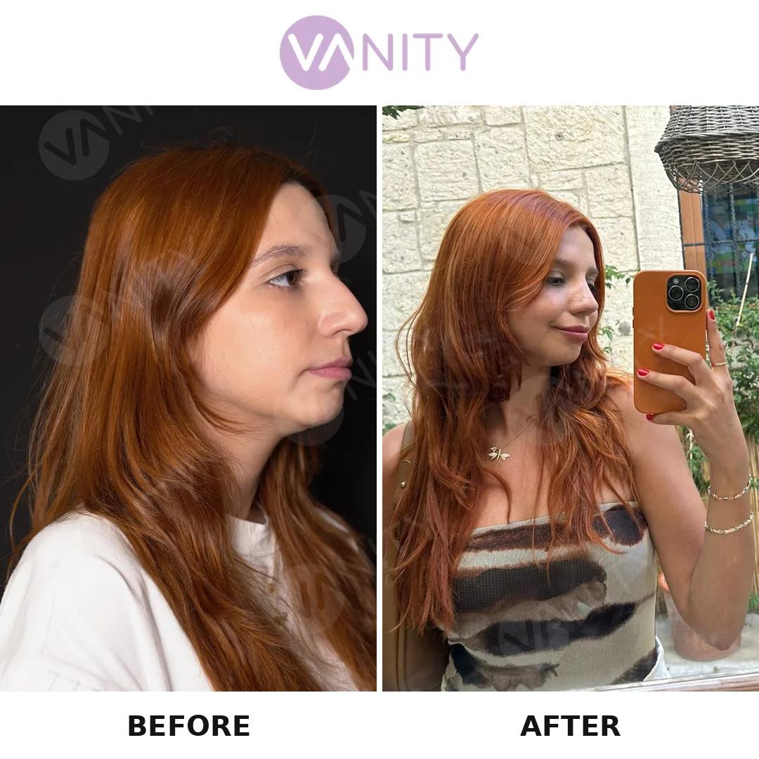 Rhinoplasty Istanbul